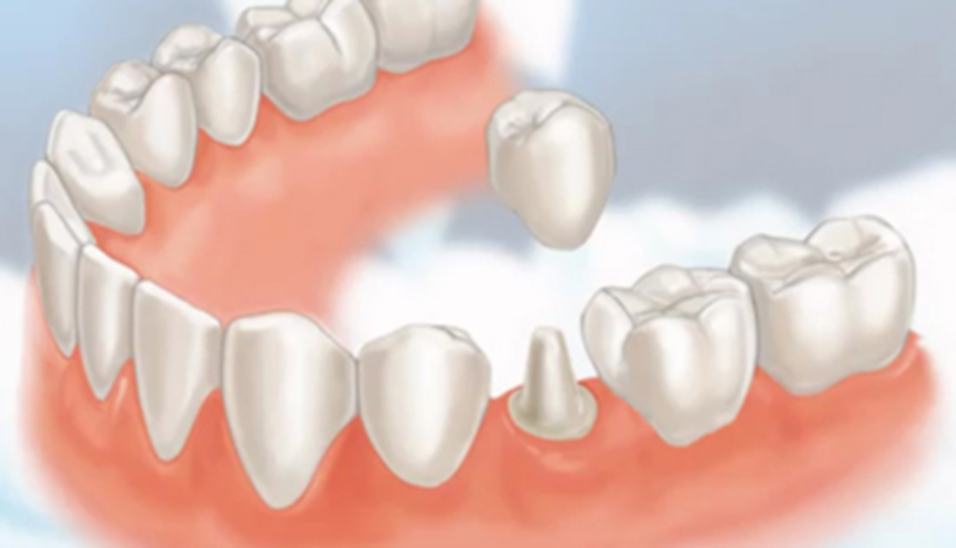تلبيس الاسنان أو تاج الاسنان هو غطاء يشبه الأسنان يوضع فوق الأسنان في اللثة، وتكون هناك حاجة إليه لدعم سن ضعيف أو لجعل السن يبدو بمظهر أفضل.