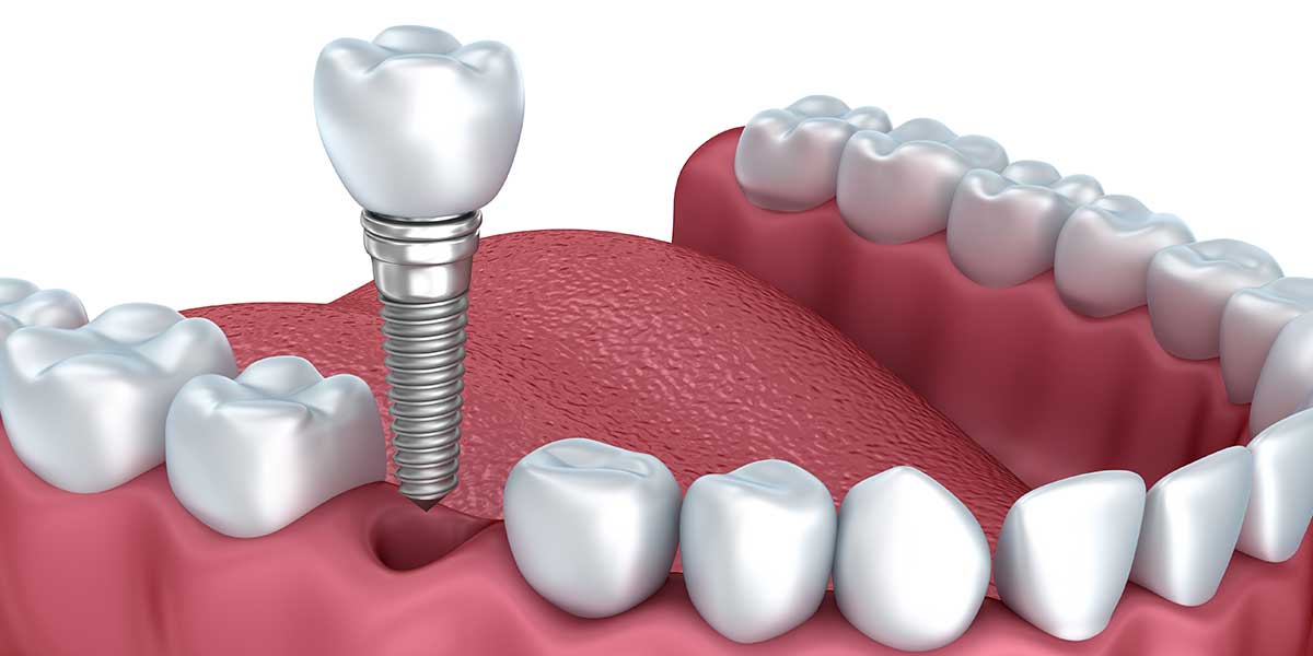 زراعة الأسنان (بالإنجليزية: Dental implants) هي طريقةٌ شائعةٌ ومجديةٌ لتعويض الأسنان المفقودة، وتُصمَم بطريقةٍ تتلاءم مع الأسنان الأخرى الموجودة في الفم