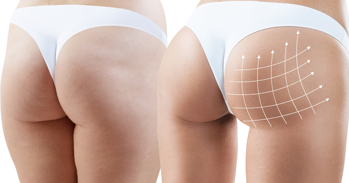 Buttock augmentation, or gluteal augmentation, is used to improve the contour, size and/or shape of the buttocks.