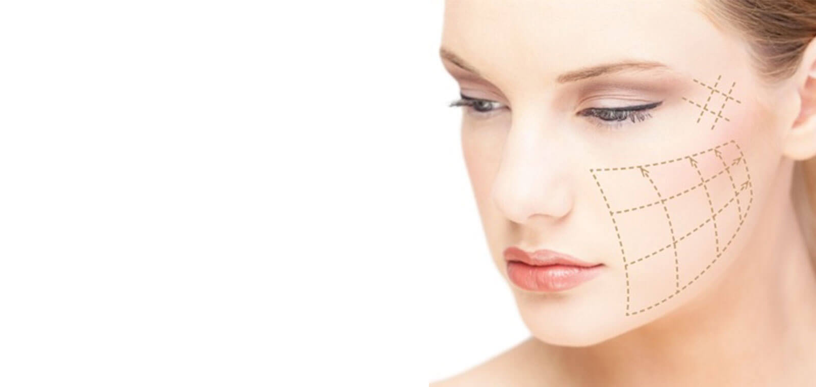 Injectable lifting with yarns is a safe method which gives lifting results to loosened tissues avoiding surgery.